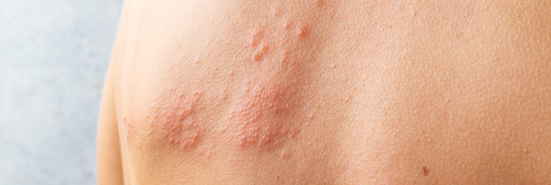 Herpes zóster: ¿cuándo hay que preocuparse?