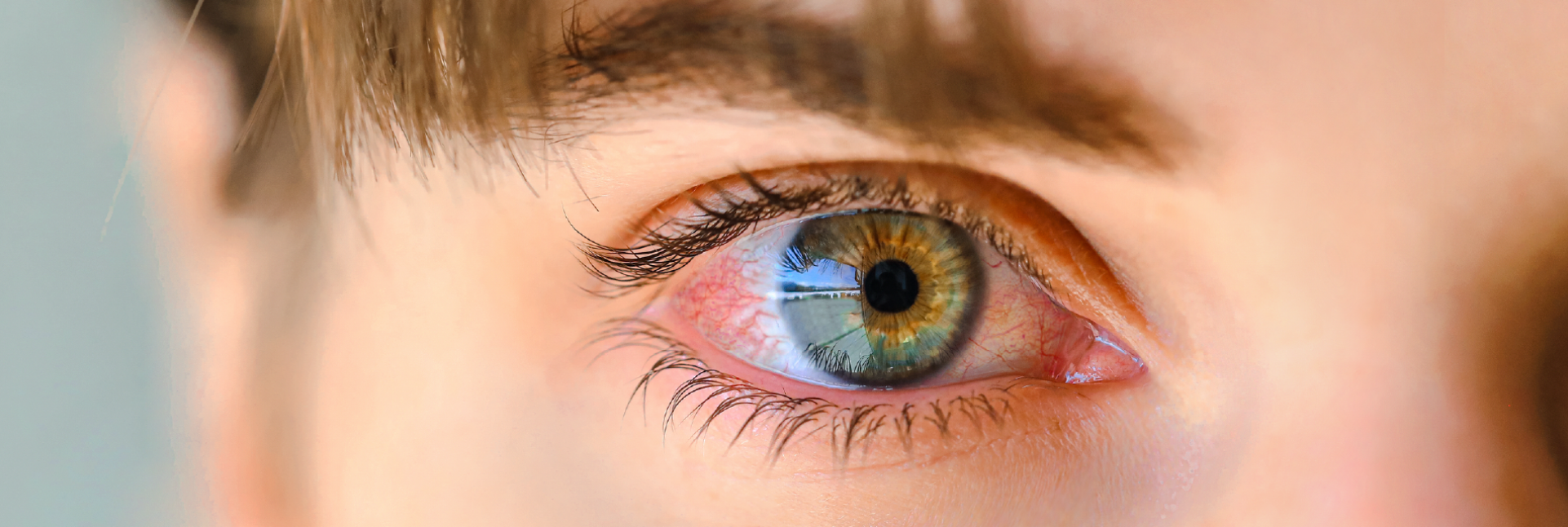 Rosácea ocular: síntomas, causas y tratamiento