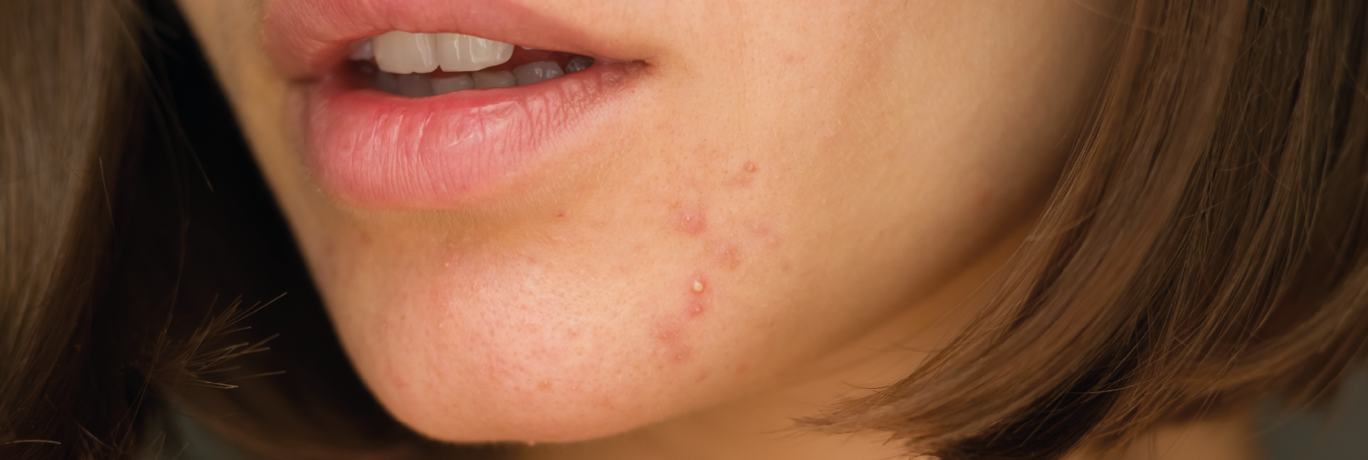 5 consejos para prevenir el acné hormonal