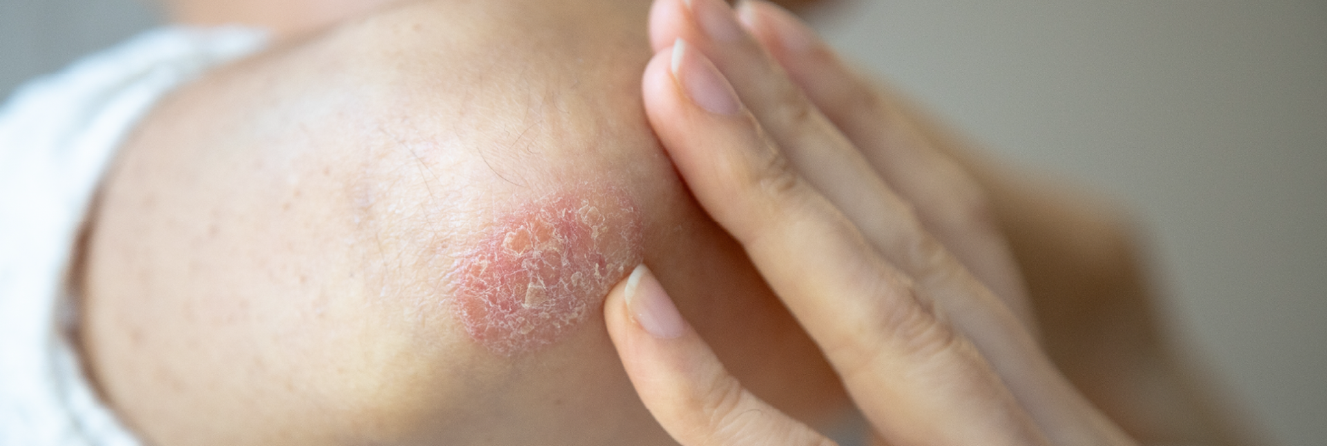 Psoriasis o eczema: ¿cómo distinguirlos?