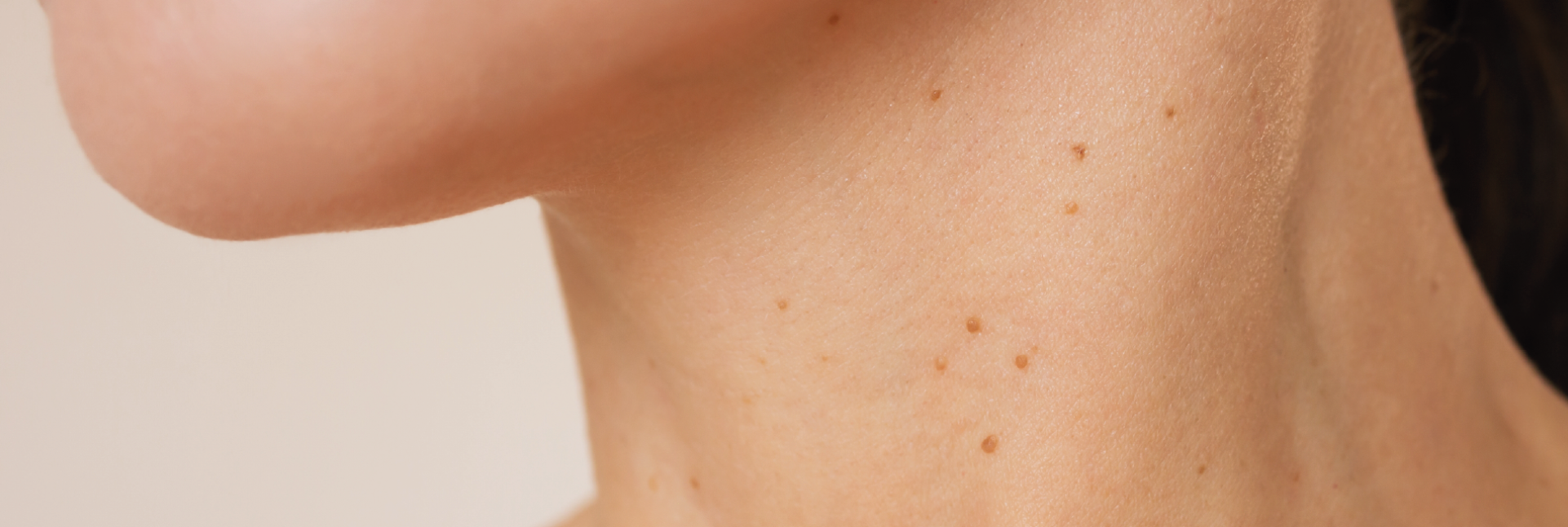 Verrugas en el cuello: causas, tipos y tratamiento