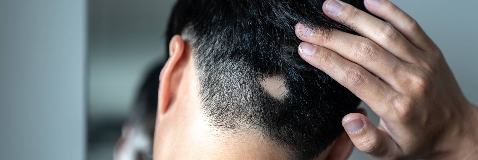 Alopecia areata: causas y tratamiento
