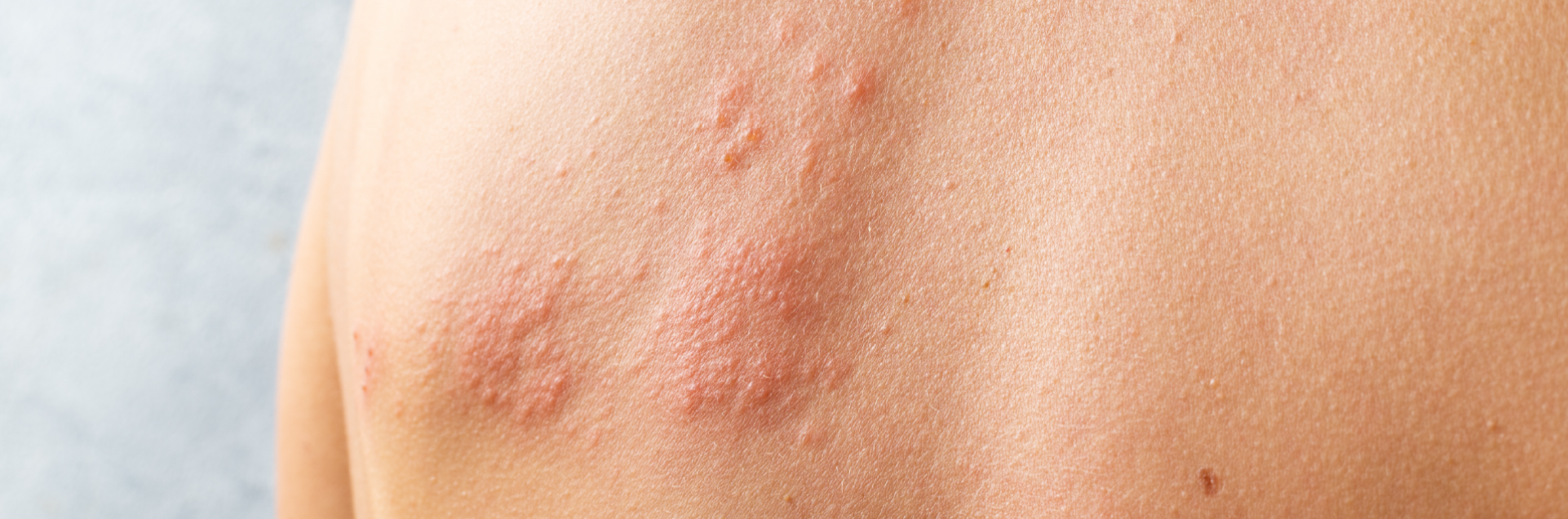 Herpes zóster: ¿cuándo hay que preocuparse?