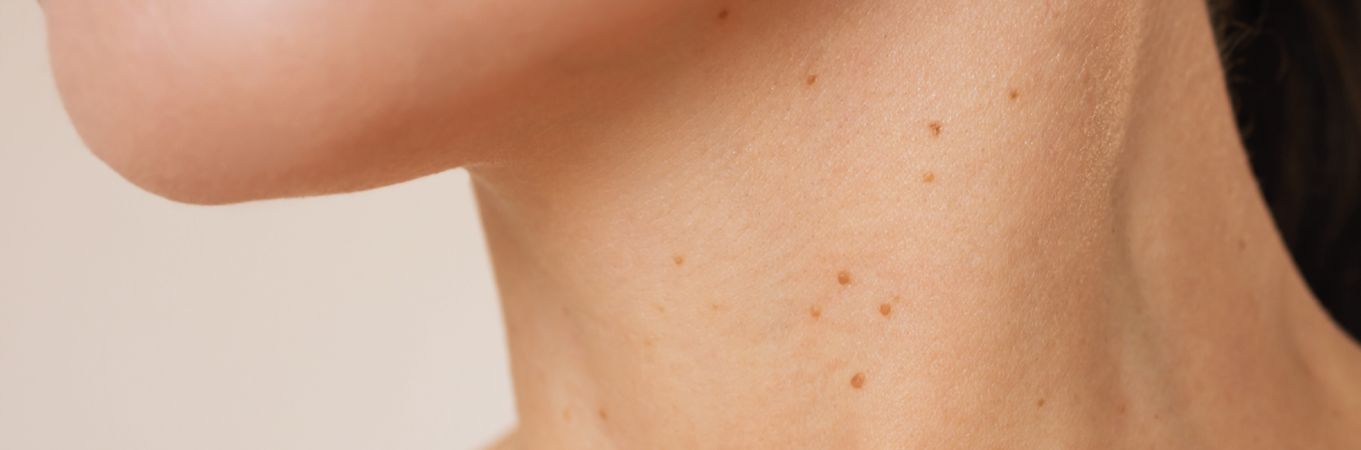 Verrugas en el cuello: causas, tipos y tratamiento